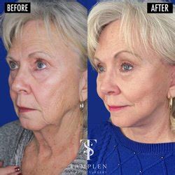 Tamplen Plastic Surgery – Facelift.